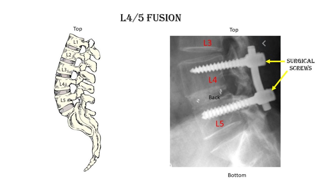 L 45 Fusion Indications Complications And Treatments 