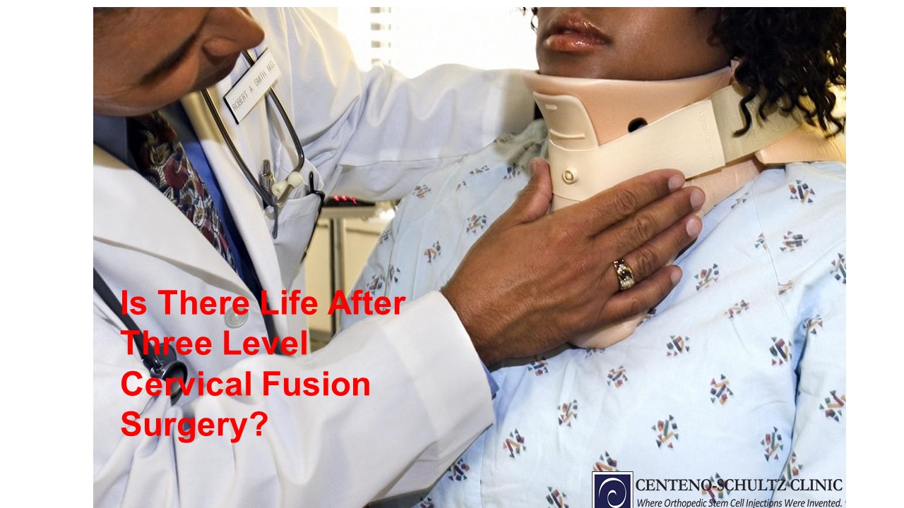 life after three level cervical fusion surgery