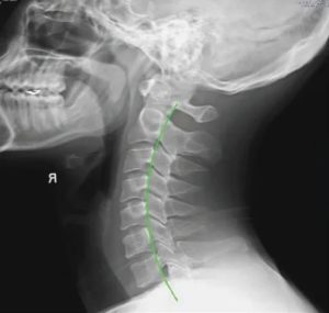 Lordosis Of Cervical Spine. Best 300x285 