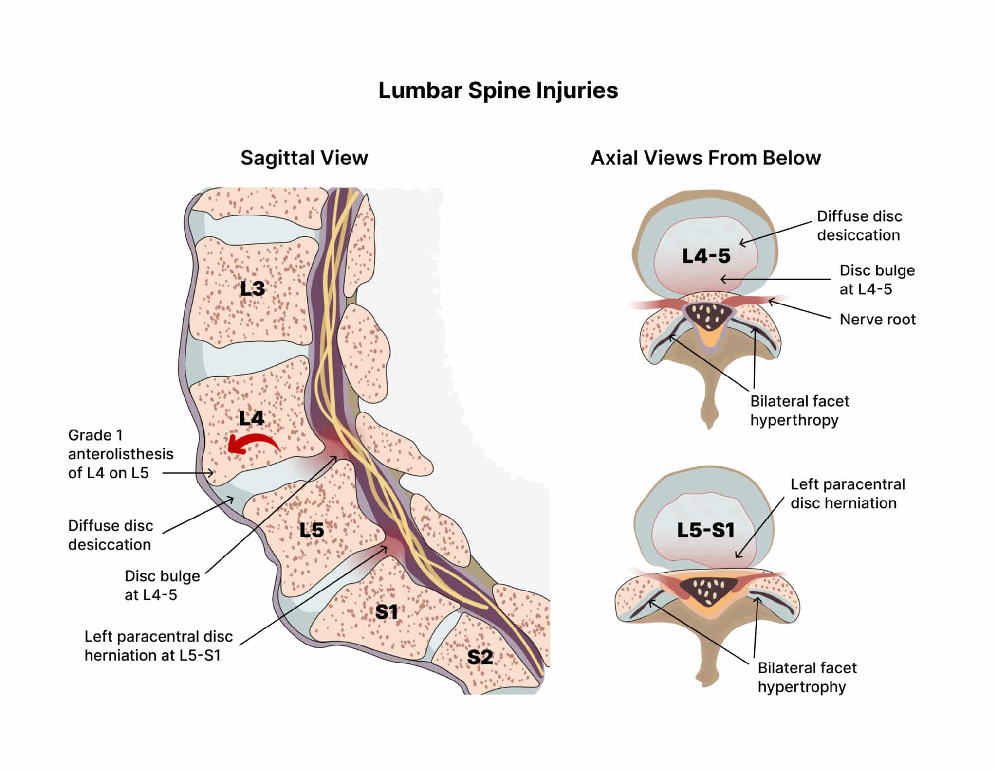 What You Need To Know About The L5 S1 (Lumbosacral Joint)