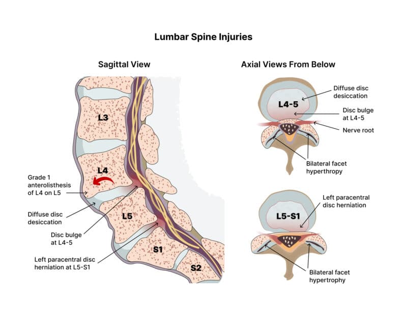 What You Need To Know About The L5 S1 (Lumbosacral Joint)