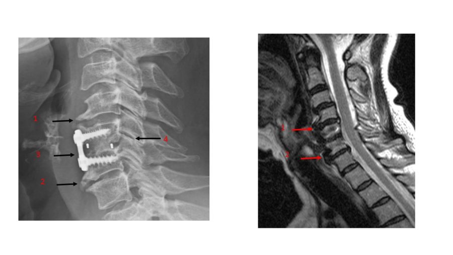 Neck Surgery and Its Consequences: Adjacent Segment Disease