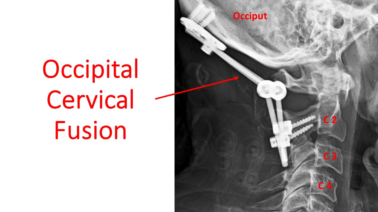 occipital cervical fusion