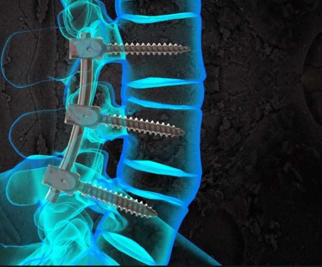 PLIF surgery - fusion of spine