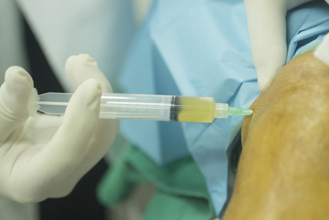 what to expect after prp injection