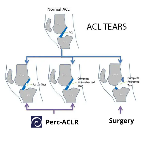 What types of ACL tears does the Perc-ACLR treat?
