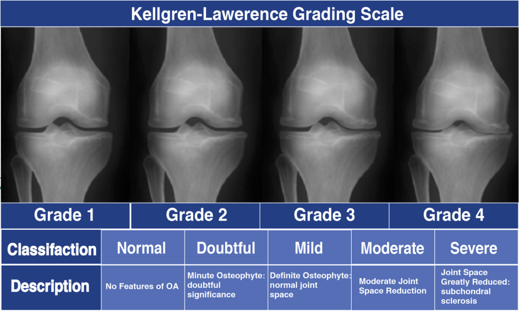 Arthritis Knee Young Age at Lena Gant blog