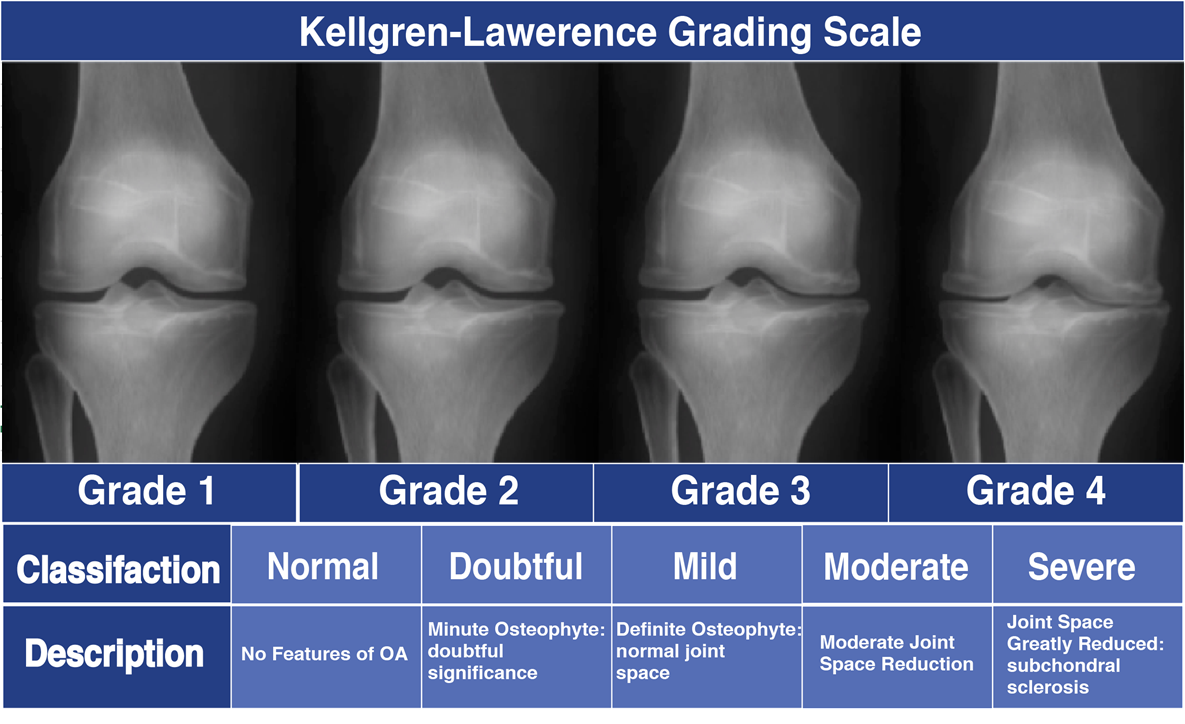 Knee Arthritis Causes, Symptoms, and Treatment CSC