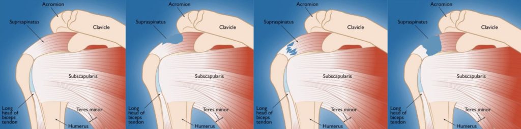 Does a Partial Rotator Cuff Tear Get Bigger Over Time? - Regenexx