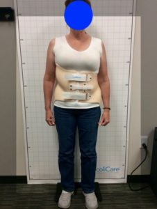 Intensive Scoliosis Treatment in Fort Collins, CO, Fort Collins Back Pain