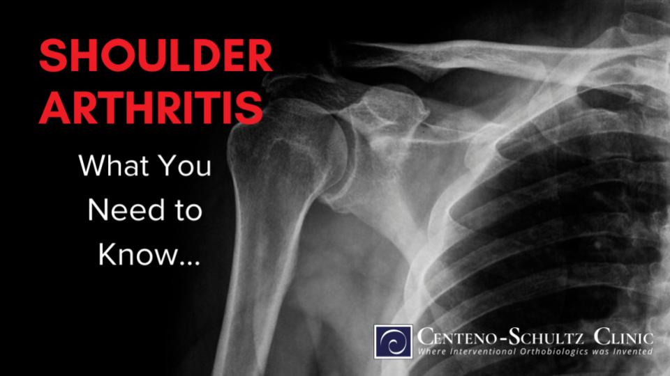 Arthritis in Shoulder - Centeno-Schultz Clinic