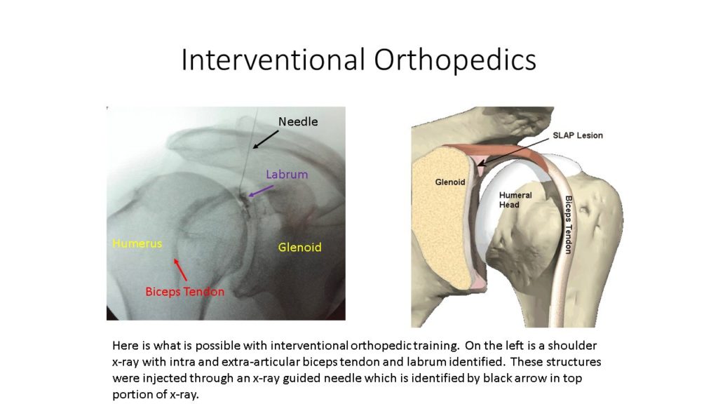 What Is Interventional Orthopedics? ~ Centeno-Schultz Clinic