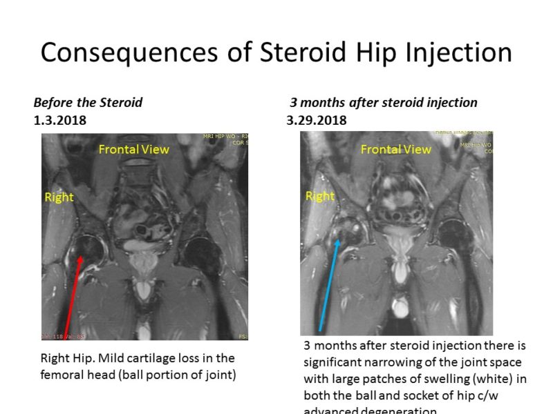 Hip Steroid Injections & Their Consequences Stem Cell Blog