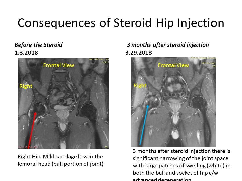 hip steroid injections