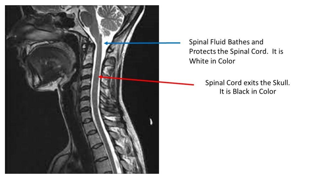 Occipital to C3 Posterior Fusion