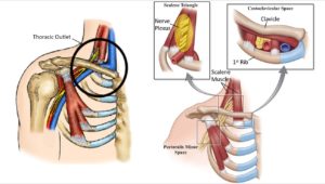 Thoracic outlet syndrome