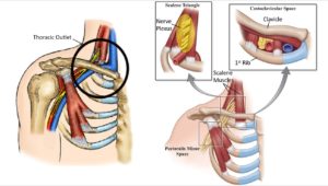 Thoracic Outlet Syndrome: More Than Just a Pain in the Neck – The