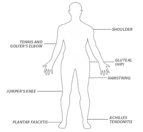 Areas treated with Tenex Procedure - plantar fasciitis, Jumper's Knee, tennis elbow, and more.