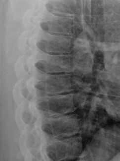 Thoracic spine x-ray