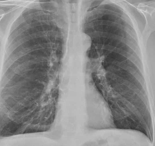 Thoracic spine x-ray