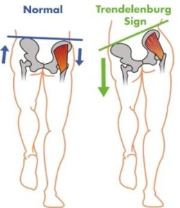 Gluteus Medius Pain: Is This Causing Your Butt Pain? - CSC