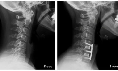 Anterior cervical discectomy and fusion