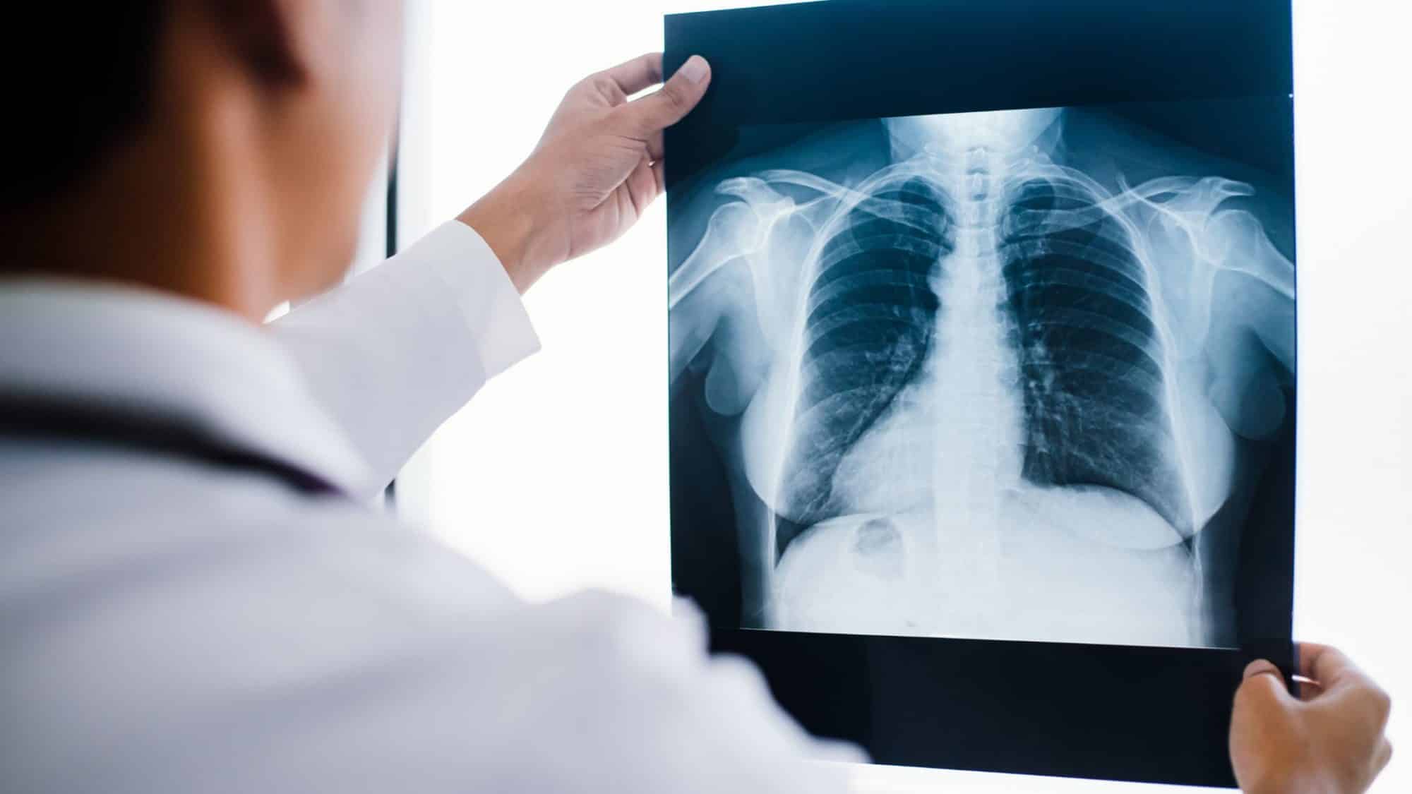 Thoracic Spine X-Ray: Diagnosing Spinal Conditions