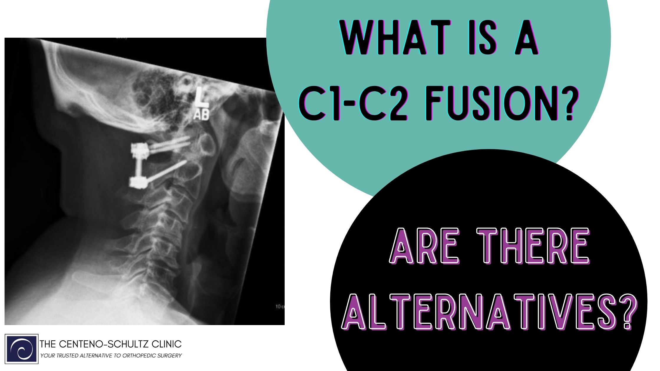 Occipital to C3 Posterior Fusion