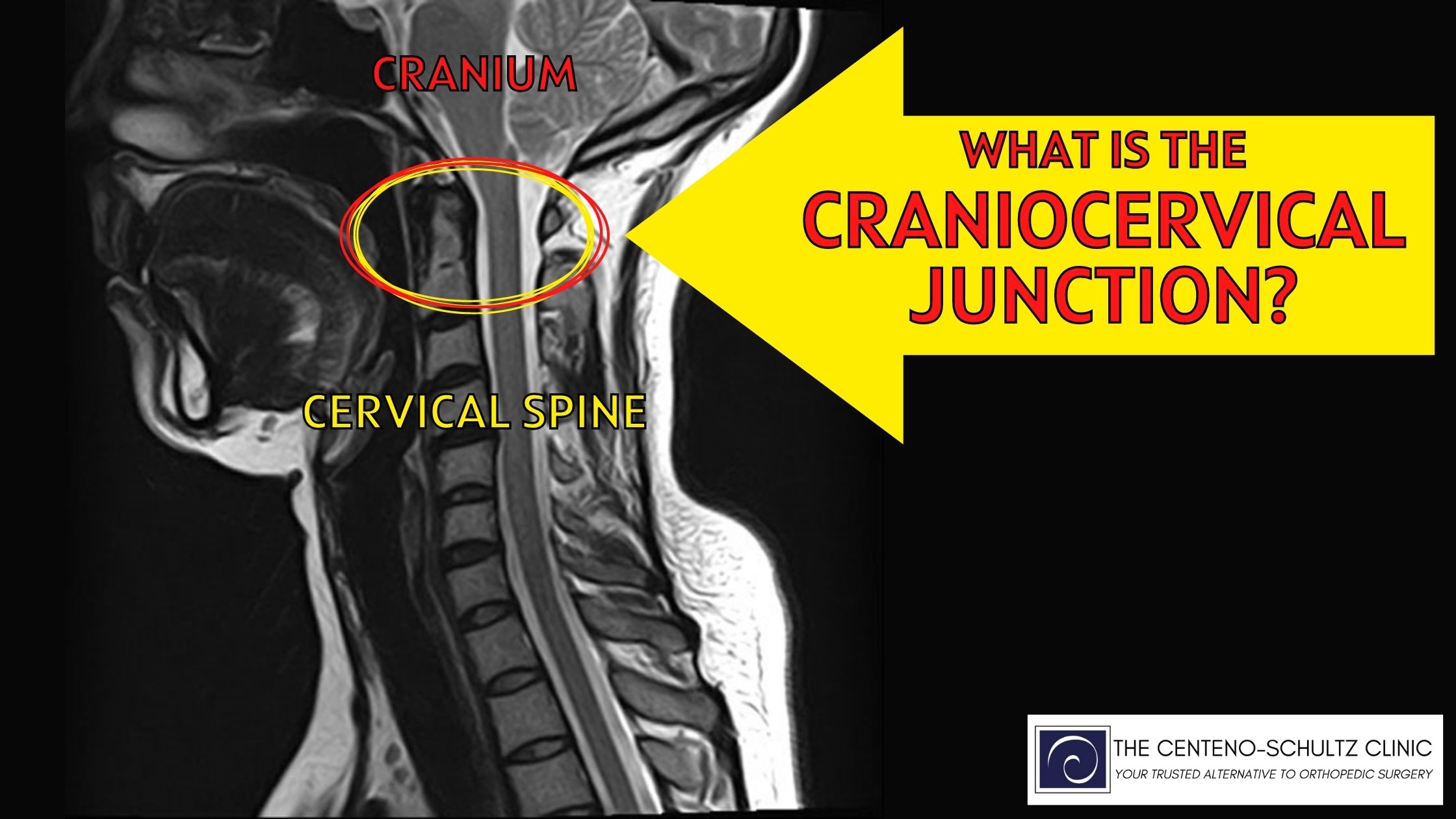 What is Craniocervical Junction?