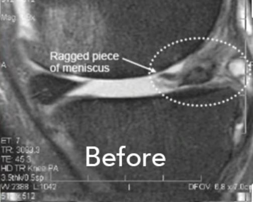 MRI - Before the Perc-MTI procedure - the trusted alternative to meniscus surgery