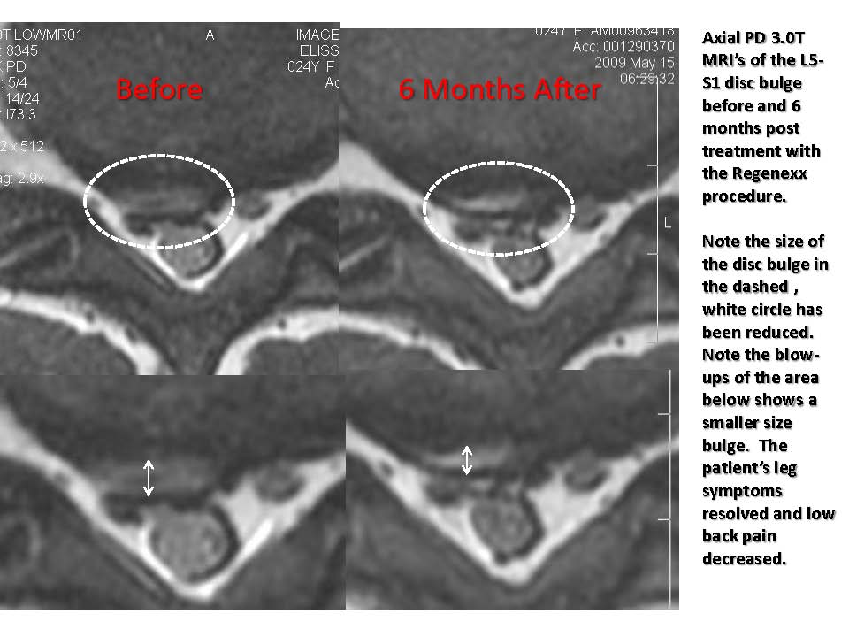 A Stransky L5-S1 Disc_Page_1