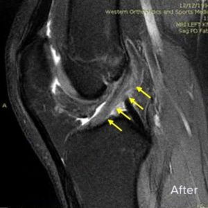 Regenexx Non-Surgical Treatment for ACL Tear in Colorado