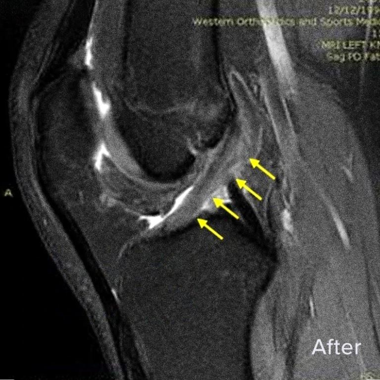 ACL tear before the Perc-ACLR procedure, the trust alternative to ACL surgery