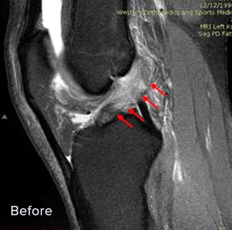 ACL tear before the Perc-ACLR procedure