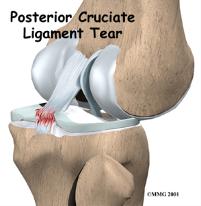 acl-sprain