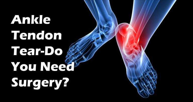 Do You Have an Ankle Tendon Tear? Most don't need surgery...