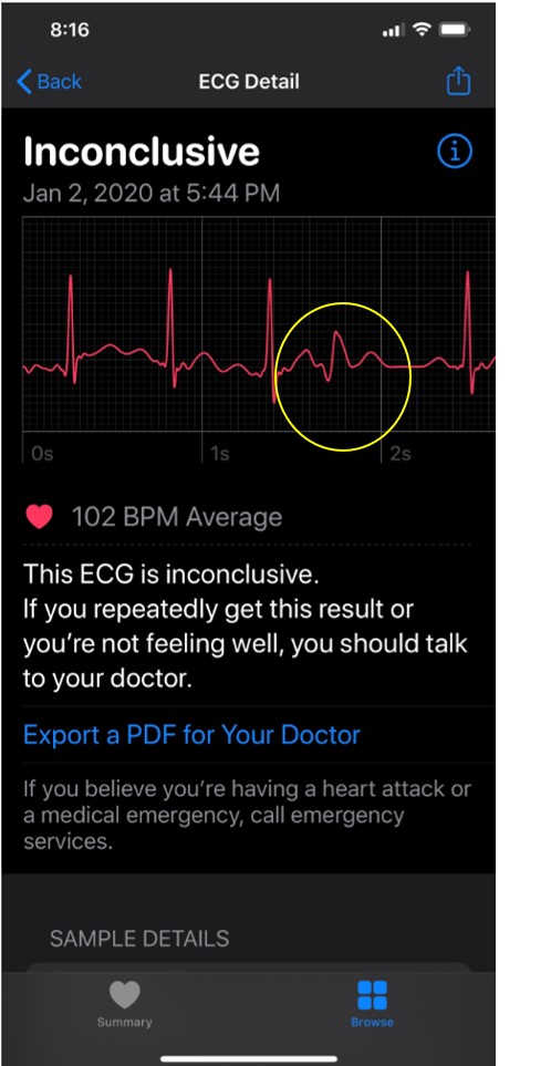 Ecg inconclusive apple store watch