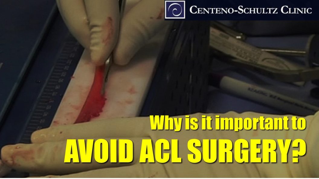 avoid acl surgery