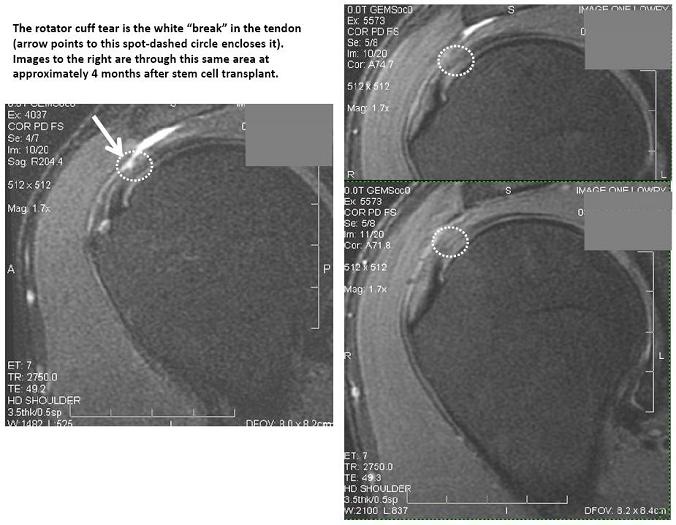 blog-rotator-cuff1