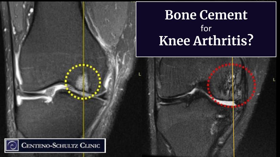 your arthritic knee injected with bone cement