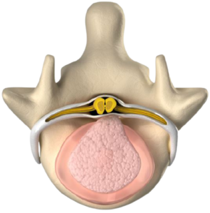 Alternatives to Back Surgery | Broomfield & Denver