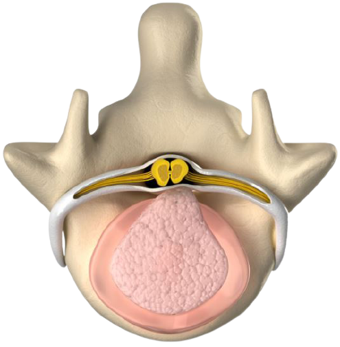 bulging and herniated discs - alternatives to back surgery