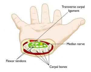 tendonitis vs carpal tunnel