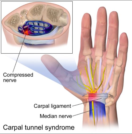 With the Perc-CT SR, you keep your carpal ligament. It's the carpal tunnel treatment without surgery.