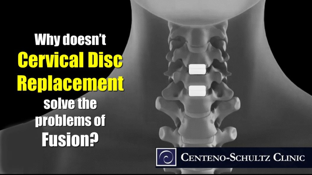 cervical disc replacement procedure