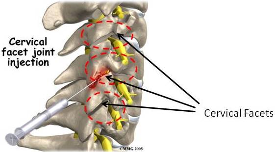 Facet Joint Syndrome - Centeno-Schultz Clinic