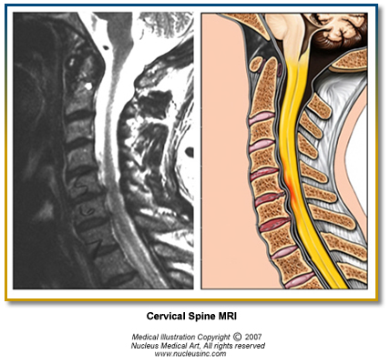 Cervical_Spine_MRI