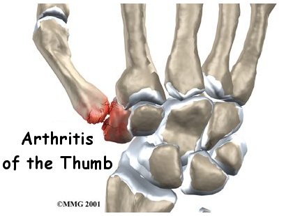 Arthritis of the Base of Thumb