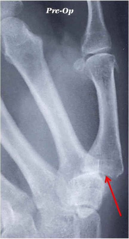 Displacement of Thumb Joint