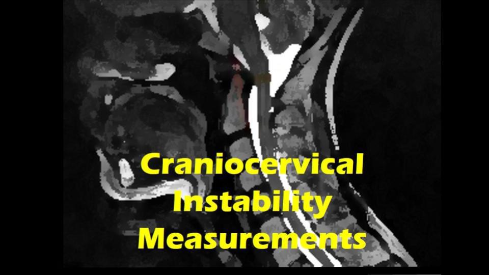 craniocervical instability